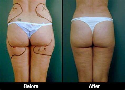 Flanks Lipo Before After 0005 Liposuction Thigh Liposuction Thighs