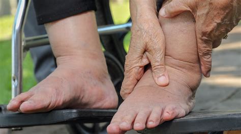 Swollen Ankles In Elderlypng
