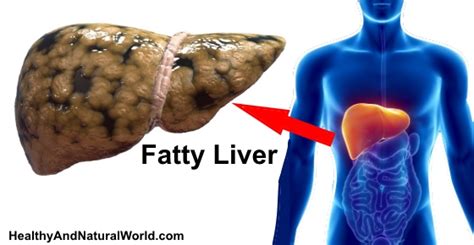Fatty Liver Signs Symptoms And How To Prevent It