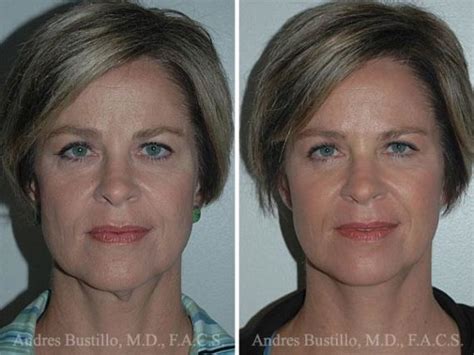 Minimal Incision Neck Lift Before And After Photos Dr Bustillo