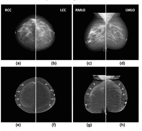 Figure 1 From Challenges In Contrast Enhanced Spectral Mammography