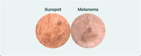 Sunspot Or Skin Cancer Know The Difference Molemap