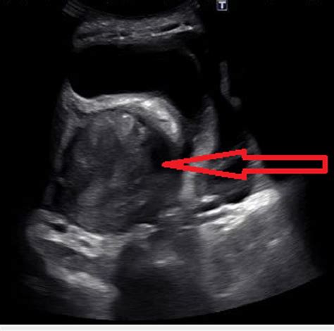 Transvaginal Ultrasound Showing A Large Septate Cystic Lesion In The