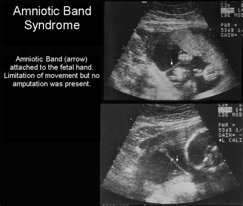 Amniotic Band Syndrome Abs Ultrasound Obstetric Ultrasound
