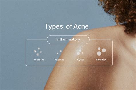 Acne Vulgaris Everything You Need To Know Software