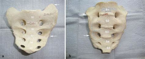A Group IB Sacrum With Five Segments And High Up Auricular Surfaces