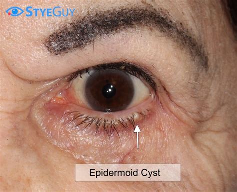 Epidermoid Cyst Styeguy