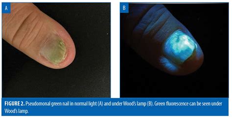 Revealing The Unseen A Review Of Woods Lamp In Dermatology Jcad