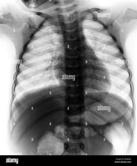 Normal Chest X Ray Of A 3 Year Old Boy Stock Photo Alamy