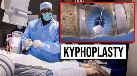 Kyphoplasty Outpatient Same Day Procedure For Vertebral Compression