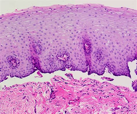 Mucous Membrane Pemphigoid Histology Mucous Membrane Pemphigoid Mmp