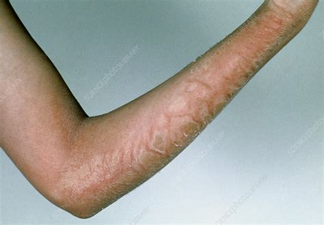 Scarlet Fever Rash On Young Persons Arm Stock Image M2600030