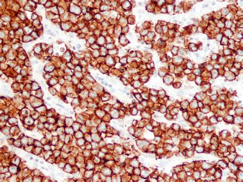 Pathology Outlines Anaplastic Large Cell Lymphoma Alk Negative