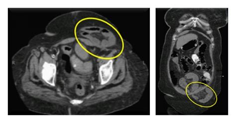 Figure 3 Mdct Of Small Bowel Obstruction How Reliable Are Oblique