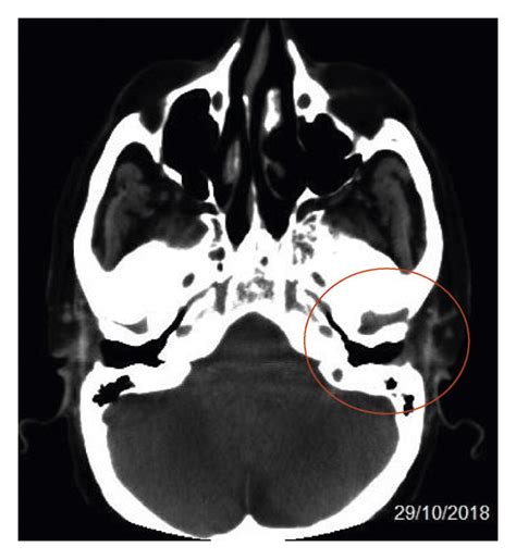 Ct Scan Of The Left Ear Without Contrast Download Scientific Diagram