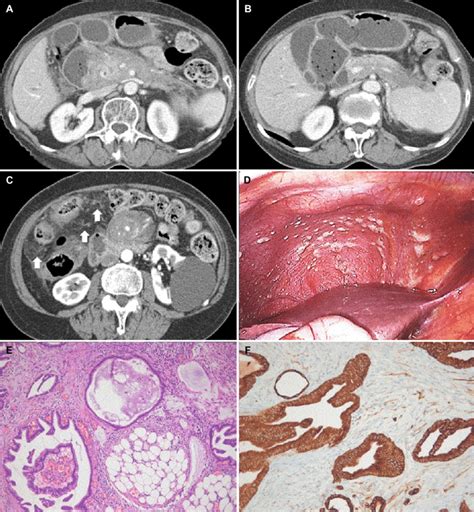 At 27 Months A B Abdominal Computed Tomography Revealed No Obvious