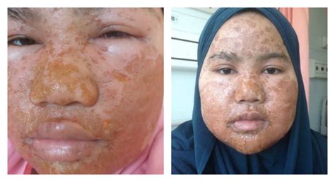 Malaysian Woman In Emergency Ward After Using Fake Korean Beauty