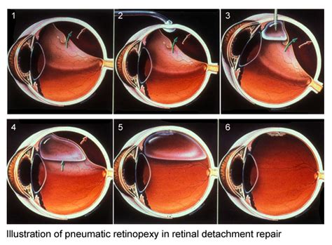Retinal Vitreous Surgery Retinal Detachment Retinal Haemorrhage