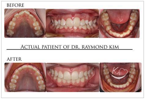 Before And After Raymond Kim Orthodontics Oakhurst Nj