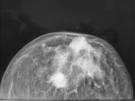 Phyllodes Tumor Digital Mammography Showing A Tumor With Irregular