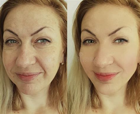 Woman Face Wrinkles Regeneration Removal Before And After Treatment