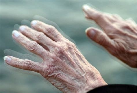 Characteristics of parkinson's disease are progressive loss of muscle control, which leads to trembling of the limbs and head while at rest, stiffness, slowness, and impaired balance. Mal de Parkinson