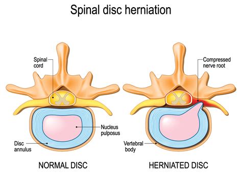 Herniated Disc Definition Causes Symptoms Diagnosis And Treatment