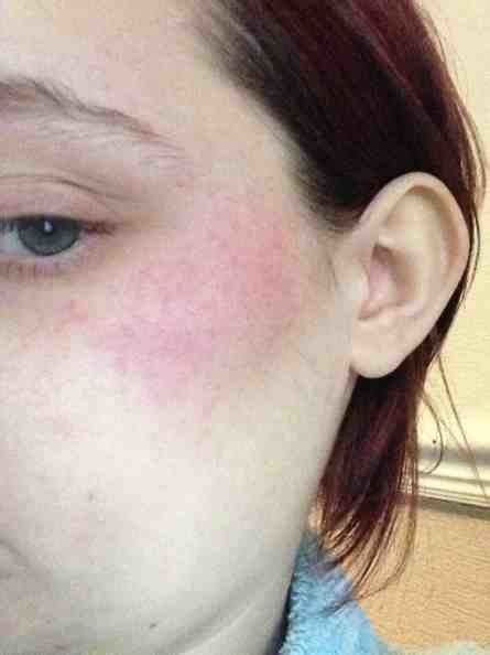 Red Rash On My Face 15 Weeks Pregnant