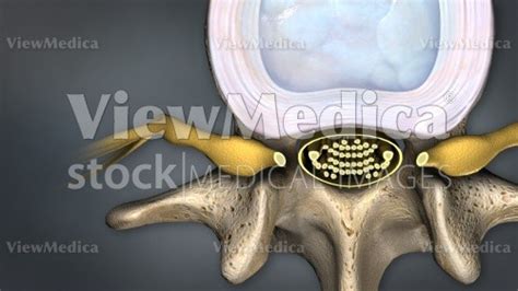 Viewmedica Stock Art Closeup Of A Lumbar Vertebra With Disc Cauda