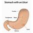 Whats Behind Your Stomach Ulcer Symptoms  University Health News
