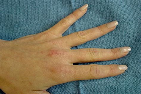 Enchondroma Hand Surgery Source