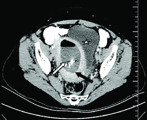 contrast enhanced pelvic axial ct scan intrauterine abscess formation download scientific