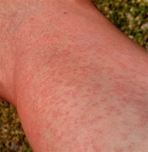 Maculopapular Rash Causes Treatment And Pictures
