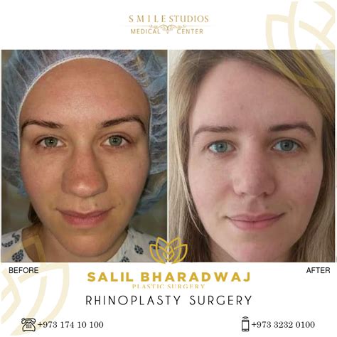 Nose Reshaping Surgery Gallery Smile Studios Best Medical Center In