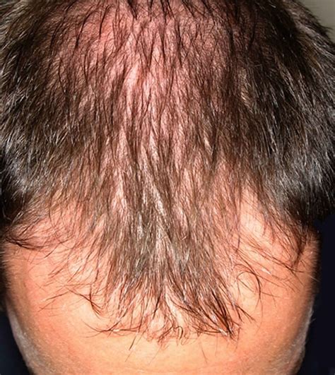 Male Or Female Pattern Baldness Causes And Baldness Treament