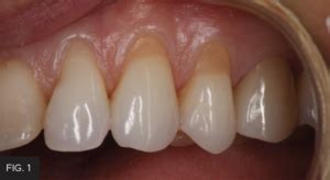 Simple Beautiful And Predictable Class V Restorations Clinician S Choice Dental Products Inc