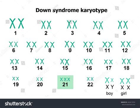 Down Syndrome Karyotype Shutterstock