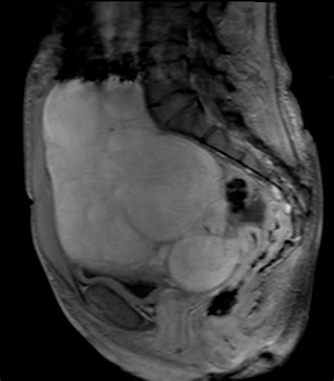 Benign Metastasizing Leiomyomas Body Mr Case Studies Ctisus Ct Scanning