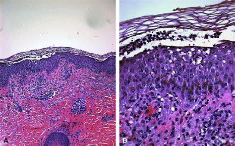 Histologic Skin Biopsy Specimen Findings Were Compatible With Diagnosis