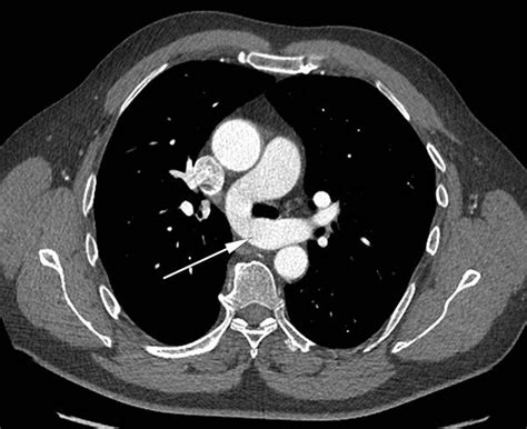 Normal Variants Radiology Normal Pulmonary