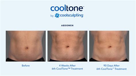 Coolsculpting Procedures Scottsdale Az Fat Removal Phoenix