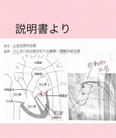 私の不整脈とカテーテルアブレーション結果について！【心室性期外収縮】 Yuckey不整脈治療をする。【心室性期外収縮】