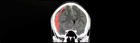 Subdural Hematoma 101 Types Symptoms Causes And Treatment