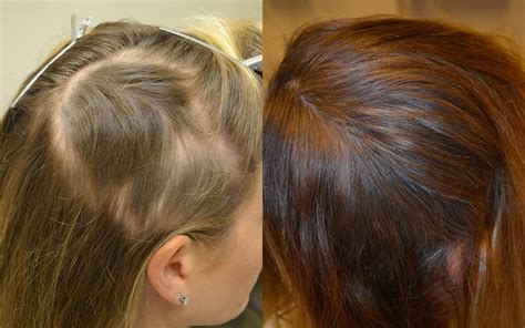 After about 10 minutes, your blood will people suffering from different kinds of alopecia such as androgenic alopecia and alopecia areata can benefit greatly in prp for hair loss injections. Alopecia Areata Treated by PRP - Platelet Rich Plasma ...