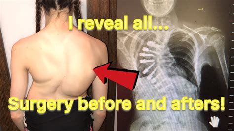 Scoliosis Surgery Before And Afters I Reveal All Youtube