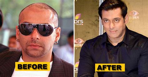 10 Bollywood Stars That Underwent The Hair Transplant Surgery