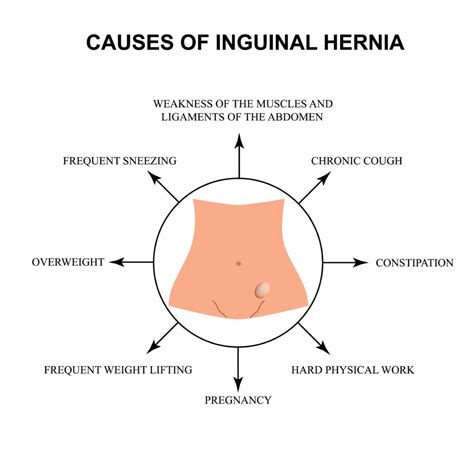 Common Types Of Hernia In Men Know Completely