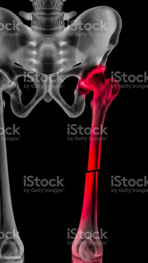 Xray Of Broken Upper Leg Or Femur Fracture Anterior View Completed