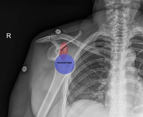 Diagnosis And Treatment Of An Anterior Shoulder Dislocation With