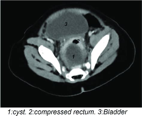 Ct Scan Transverse Cut Demonstrates The Duplicated Rectal Cyst Download Scientific Diagram